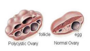PCOS.png