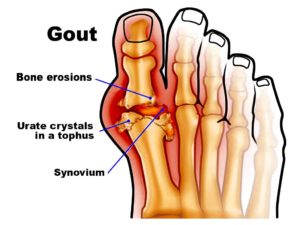 gout.jpg