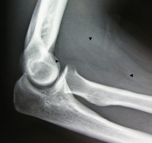 xray-elbow.jpg